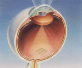 Cataract - As light passes through the cataractous lens, it is diffused or scattered. The result is blurred or defocused vision.