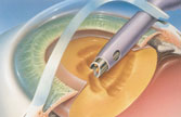 Instrument breaking up and removing pieces of clouded lens.